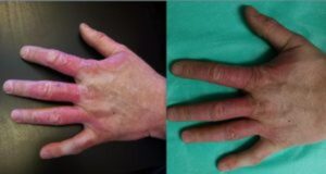 Odmrożenie gazem LPG – najczęstsze błędy, których należy unikać w leczeniu