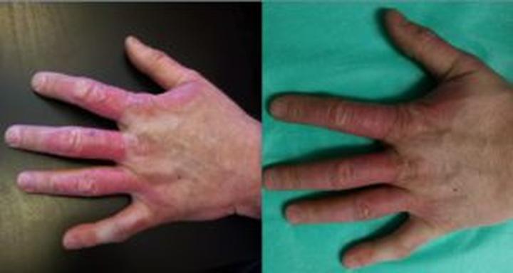 Odmrożenie gazem LPG – najczęstsze błędy, których należy unikać w leczeniu